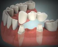 Що краще - імплант або зубний міст